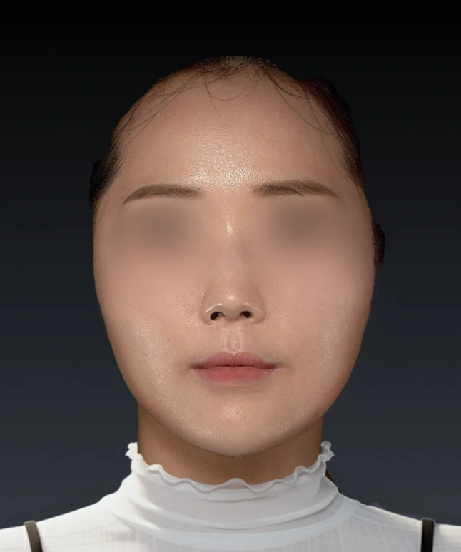 스컬트라 벨라 시술 후 얼굴 정면