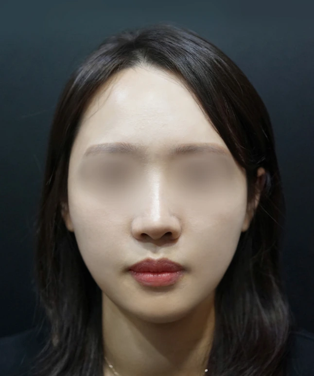 스컬트라 벨라 시술 후 얼굴 정면