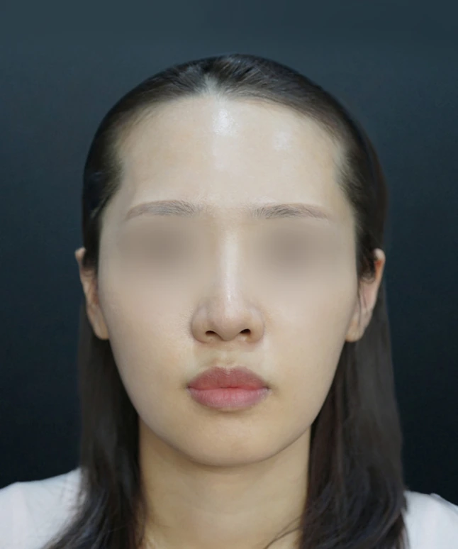 스컬트라 벨라 시술 전 얼굴 정면