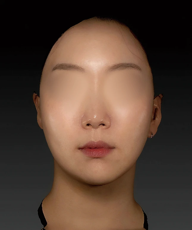 더엘주사 시술 후 얼굴 정면