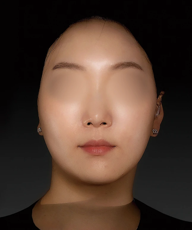 더엘주사 시술 전 얼굴 정면