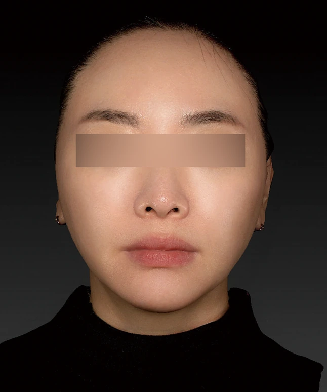더엘주사 시술 후 얼굴 정면