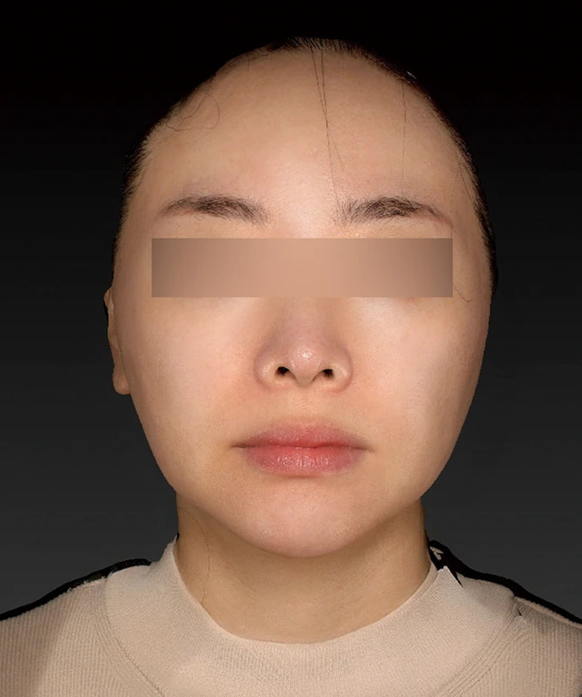 더엘주사 시술 전 얼굴 정면