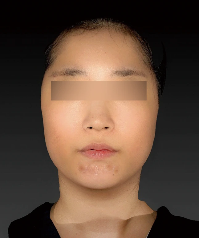 더엘주사 시술 전 얼굴 정면