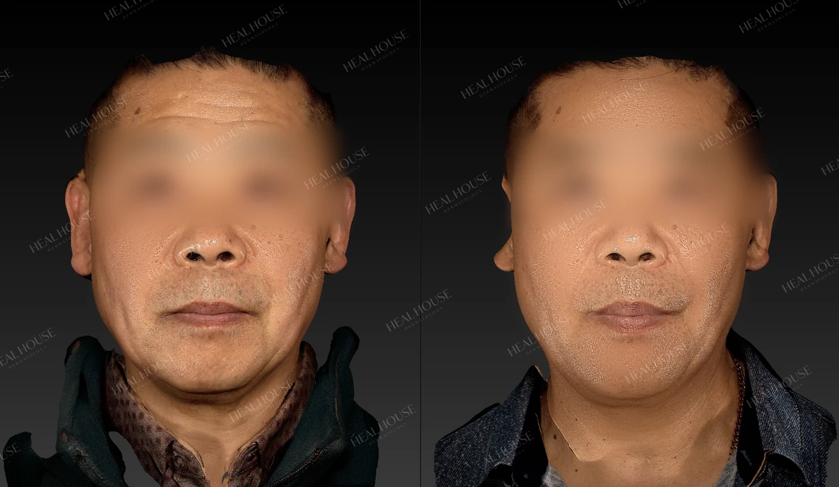 쥬브젠 자가진피재생술 사례 1 시술 전·후 비교