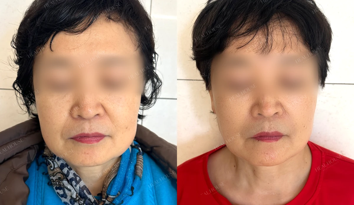 쥬브젠 자가진피재생술 사례 3 시술 전·후 비교