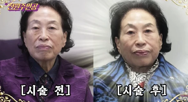 최소화한 통증, 즉각적인 아름다움 티타늄 리프팅을 선사합니다. 본문 이미지 1