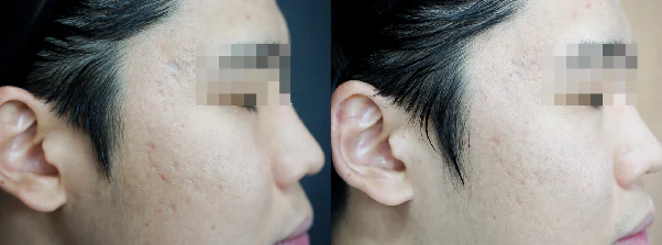 쥬브젠, 깊은 주름에 효과 있을까? 부작용, 필러와의 차이, 실제 후기 등 본문 이미지 7