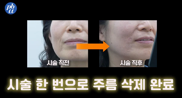 쥬브젠, 깊은 주름에 효과 있을까? 부작용, 필러와의 차이, 실제 후기 등 본문 이미지 9