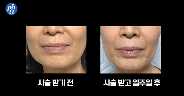 쥬브젠, 깊은 주름에 효과 있을까? 부작용, 필러와의 차이, 실제 후기 등 본문 이미지 10