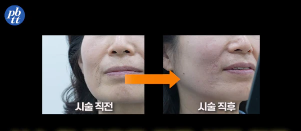 쥬브젠, 부위·깊이별 가격과 상담 전 체크리스트 본문 이미지 1