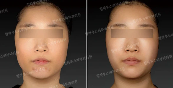 사각턱·넓은하관 때문에 얼굴이 커 보인다면? 윤곽을 정리하는 더엘주사 완전 가이드 본문 이미지 2