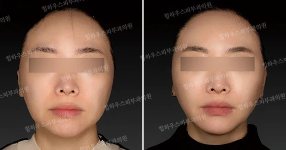 사각턱·넓은하관 때문에 얼굴이 커 보인다면? 윤곽을 정리하는 더엘주사 완전 가이드 본문 이미지 3