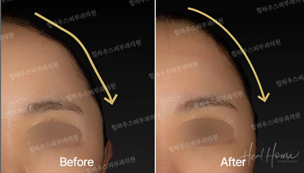 사각턱·넓은하관 때문에 얼굴이 커 보인다면? 윤곽을 정리하는 더엘주사 완전 가이드 본문 이미지 7