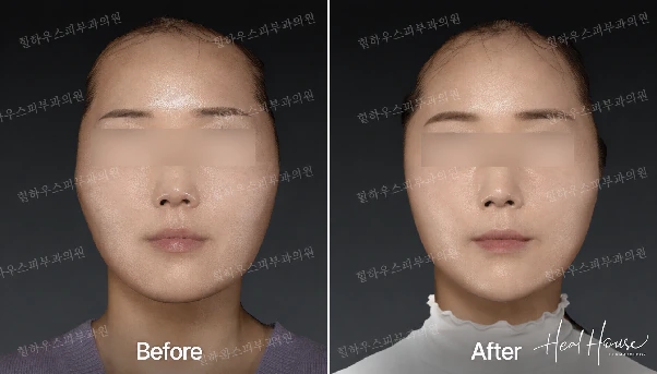 다이어트를 해도 얼굴만 커 보여요. 30대 볼패임, 무작정 채우면 안 되는 이유 본문 이미지 5