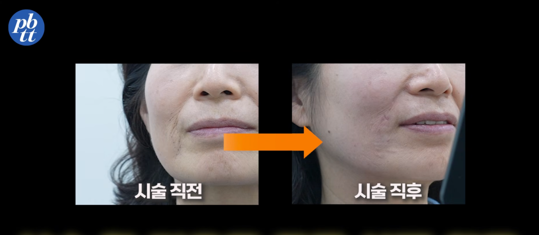 힐하우스피부과 강남점에서 쥬브젠 시술 받은 전후 비교