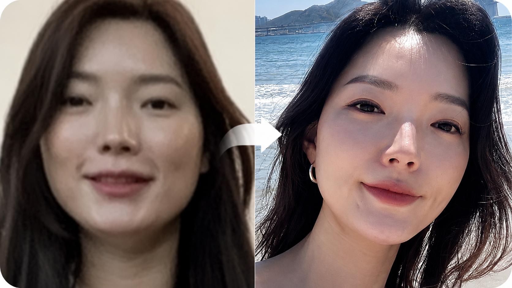 힐하우스피부과 더엘주사 시술 전후