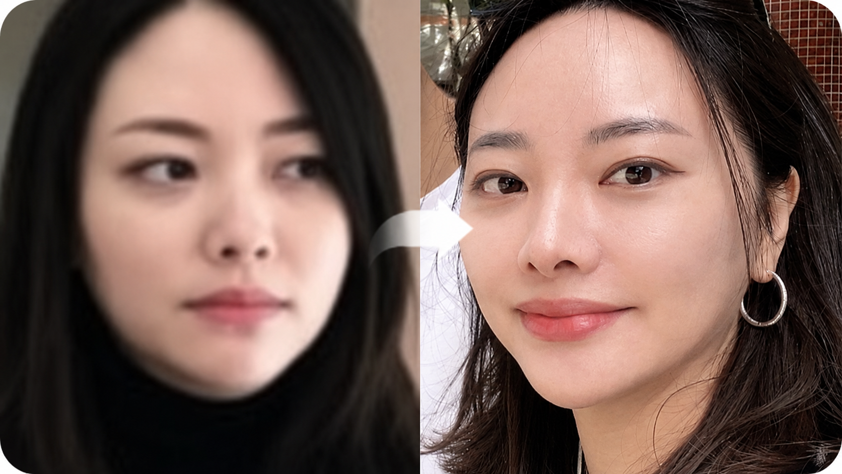 수술 없이 설계하는 프리미엄 윤곽 관리, 더엘주사를 선택해야 하는 이유 본문 이미지 19