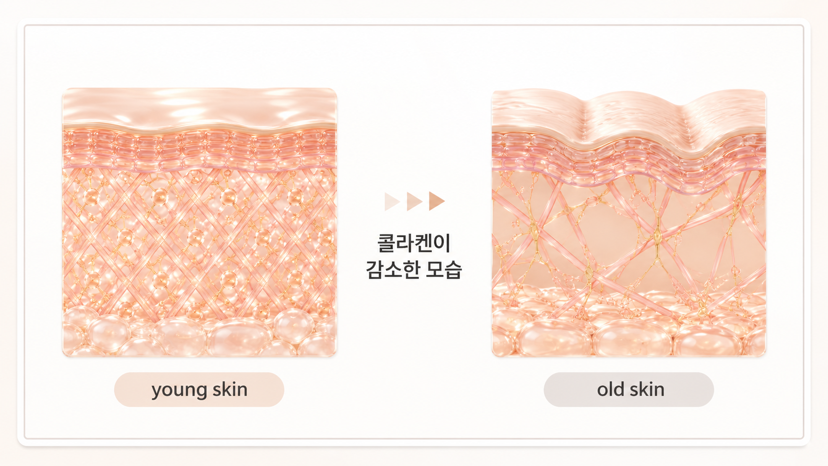 30대에 접어들면서 어린 피부와는 달리 콜라겐이 헌저하게 감소한 모습 / 힐하우스피부과 강남