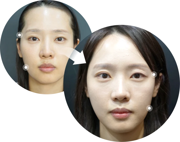 푹 꺼진 앞볼에 볼륨을 채워 입체감을 개선한 전후 비교 1
