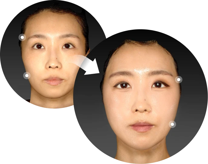 푹 꺼진 앞볼에 볼륨을 채워 입체감을 개선한 전후 비교 2