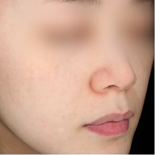 시술 후 6