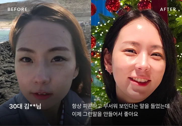 우아한 얼굴 시술 전후 비교 1