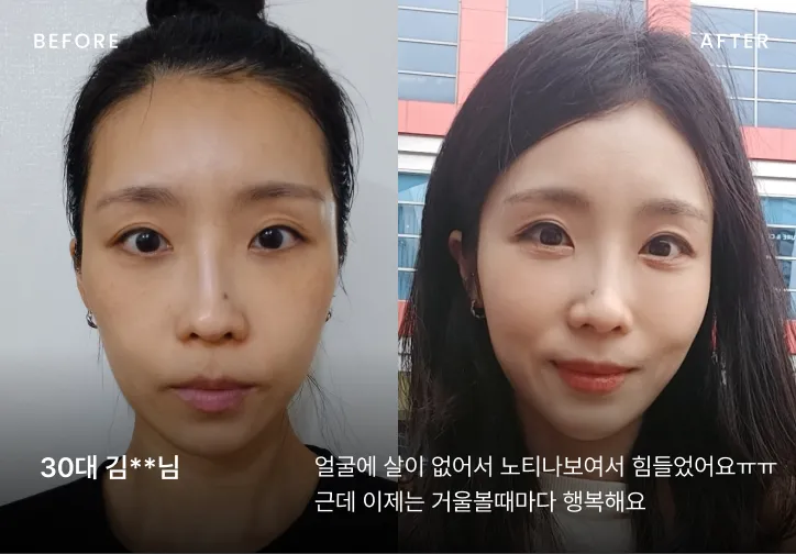 우아한 얼굴 시술 전후 비교 2