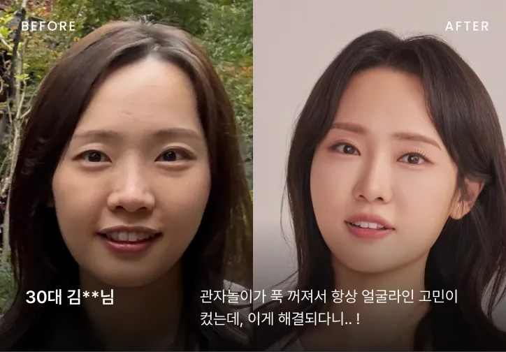 우아한 얼굴 시술 전후 비교 3