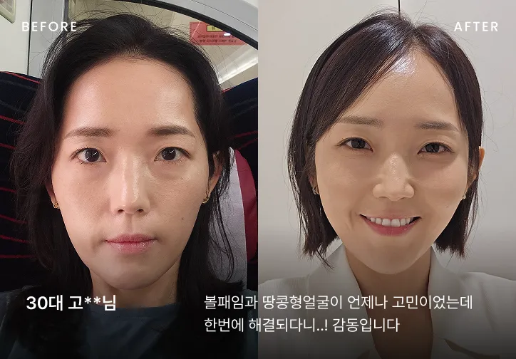 우아한 얼굴 시술 전후 비교 4