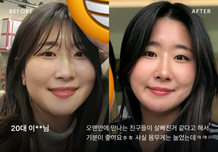 작은 얼굴 시술 전후 비교 1