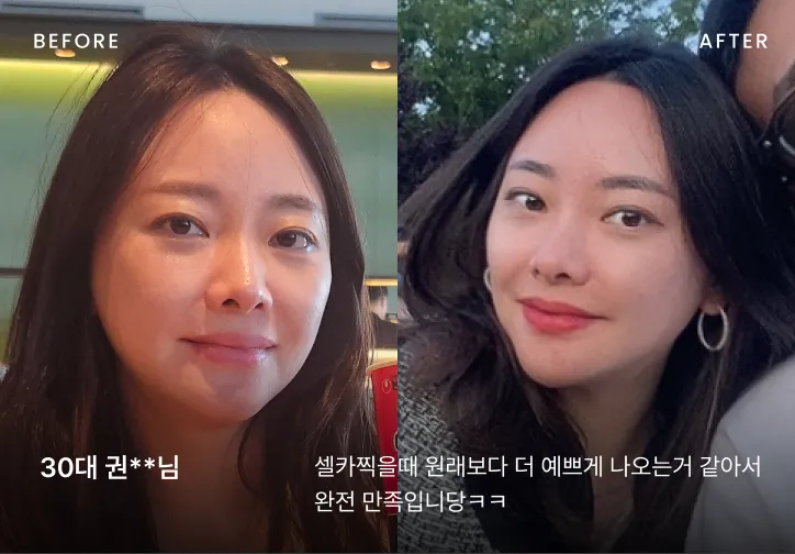 작은 얼굴 시술 전후 비교 2