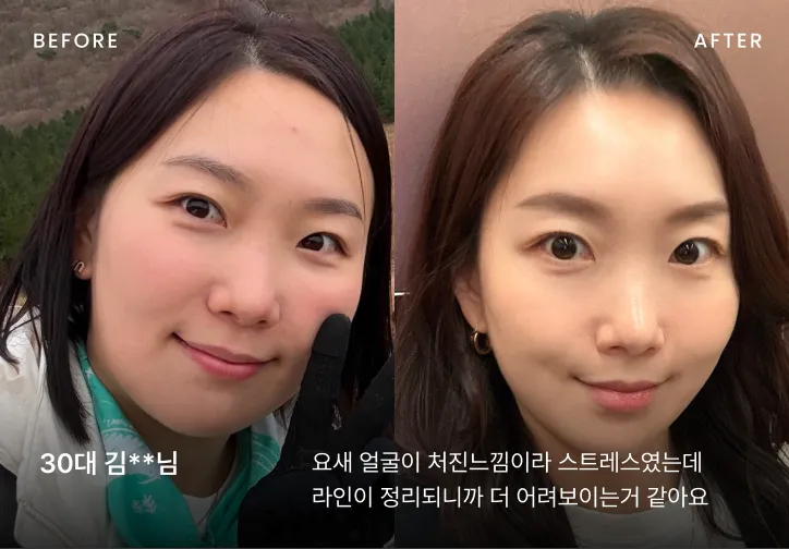 작은 얼굴 시술 전후 비교 3
