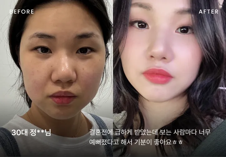 작은 얼굴 시술 전후 비교 4