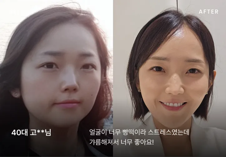 작은 얼굴 시술 전후 비교 5