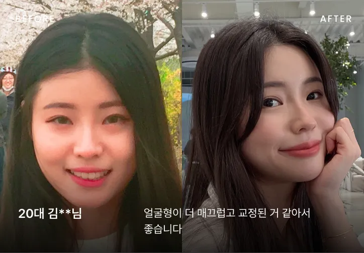 작은 얼굴 시술 전후 비교 6