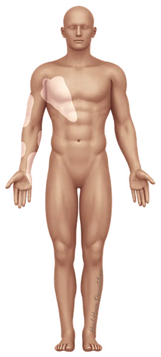 분절형 백반증의 신체 분포 일러스트