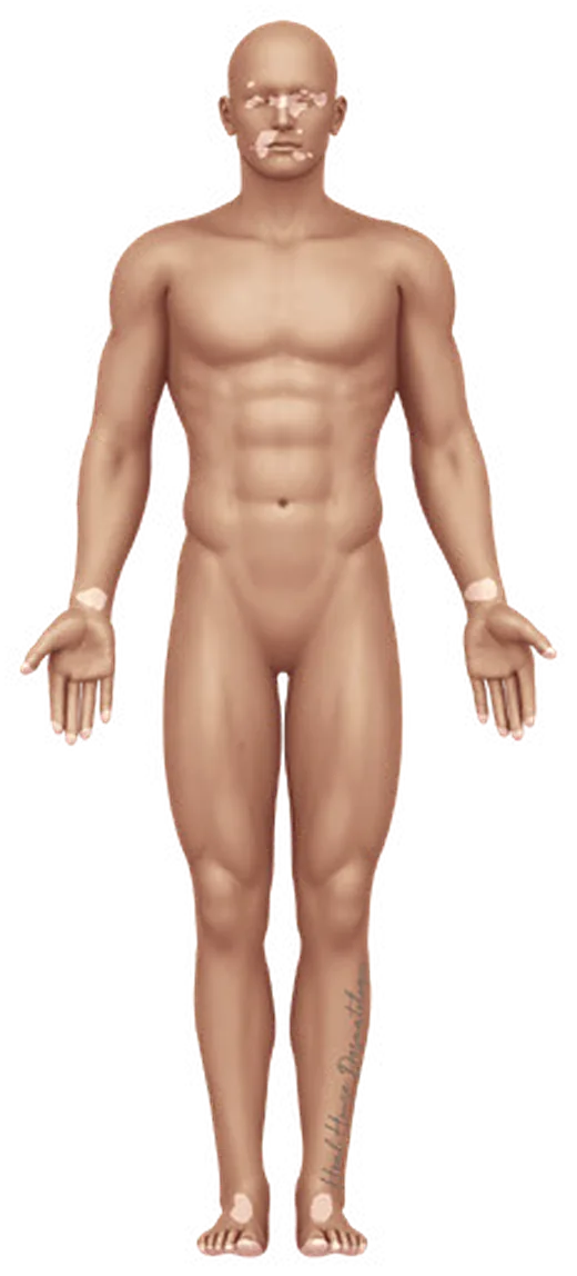 말단얼굴형 백반증의 신체 분포 일러스트