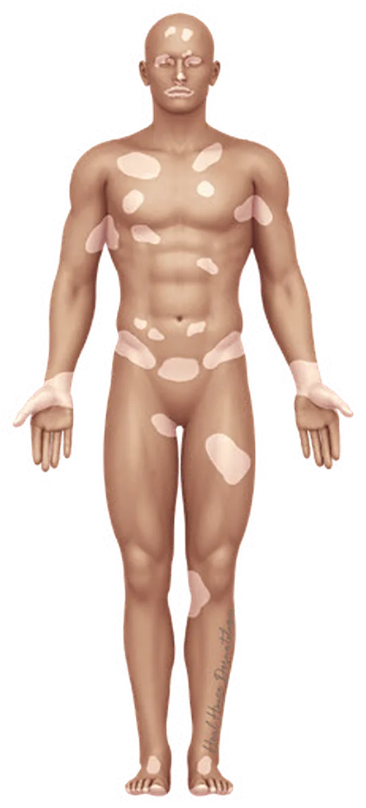 보통형 백반증의 신체 분포 일러스트
