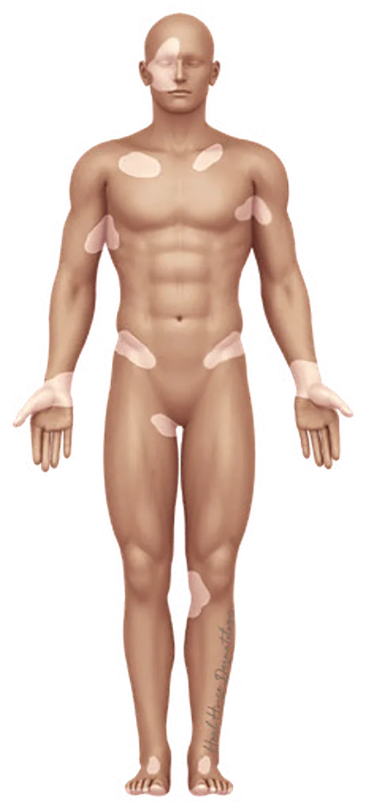 혼합형 백반증의 신체 분포 일러스트