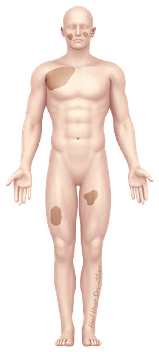 범발형 백반증의 신체 분포 일러스트