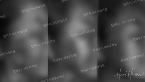 광선치료 후 1