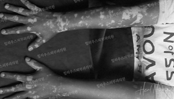 광선치료 전 2