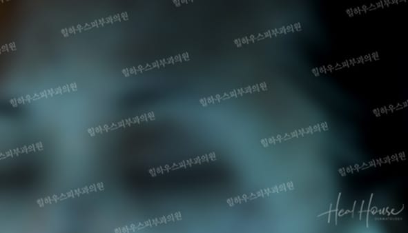 광선치료 후 3