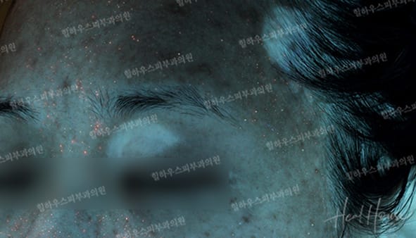 광선치료 전 3