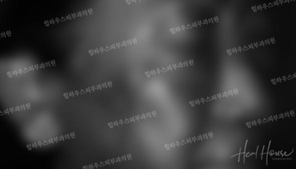 광선치료 후 4