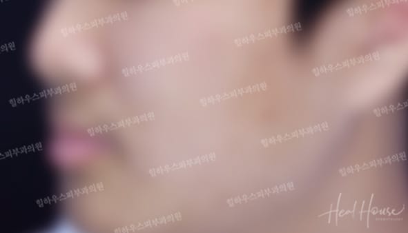 광선치료 후 6